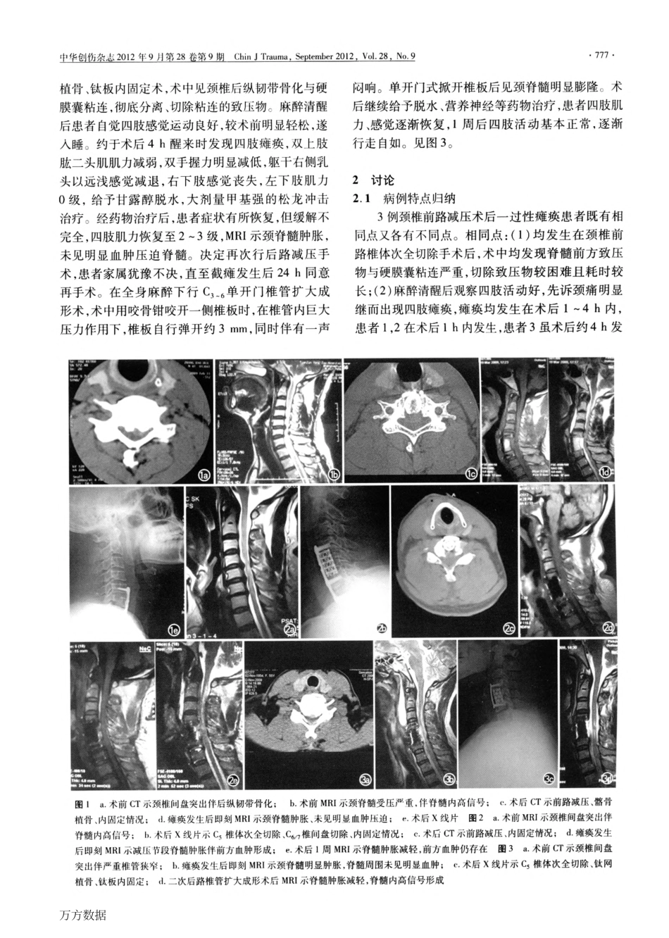 颈前路减压术后早期一过性四肢瘫痪三例原因分析_第3页