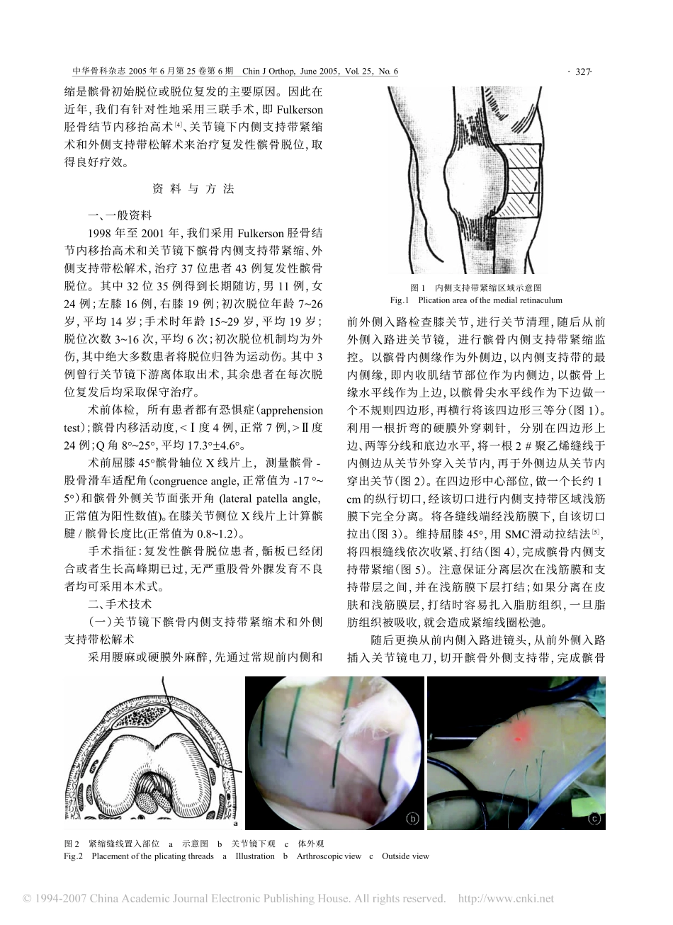 关节镜下髌骨支持带调整术治疗复发性髌骨脱位_第2页