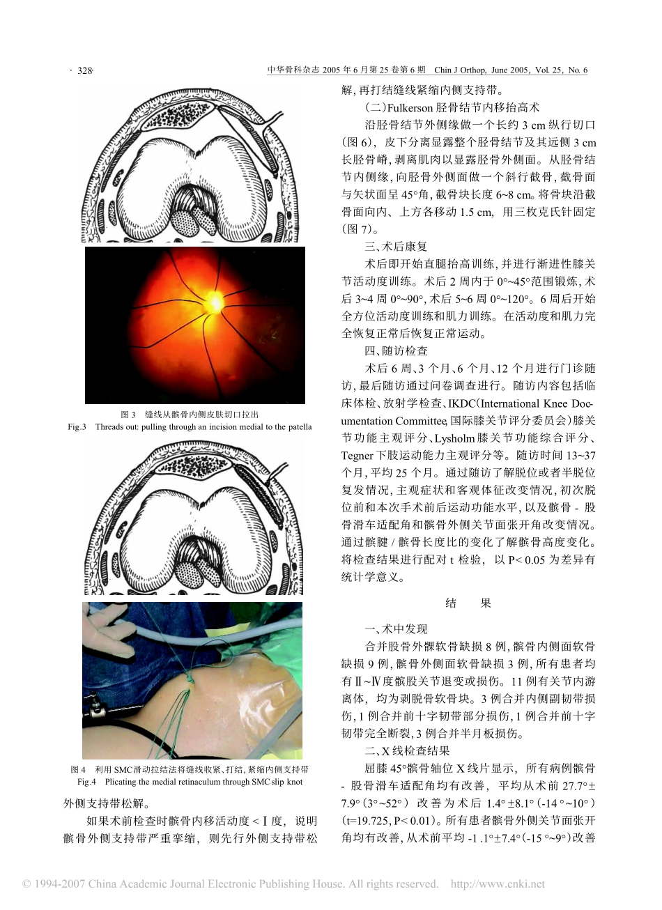 关节镜下髌骨支持带调整术治疗复发性髌骨脱位_第3页