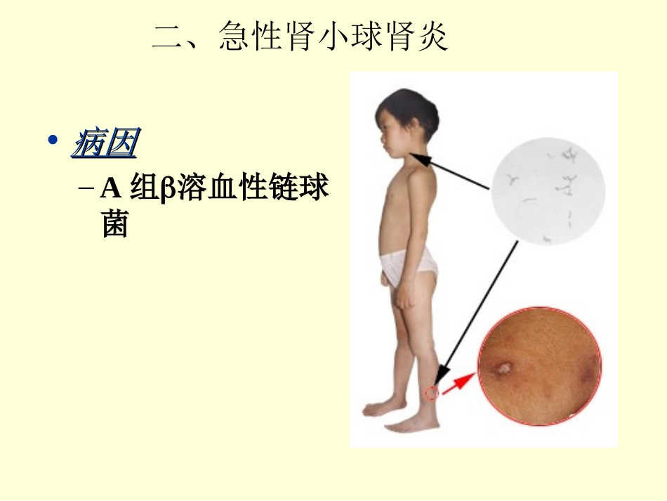 急性肾小球肾炎_第2页