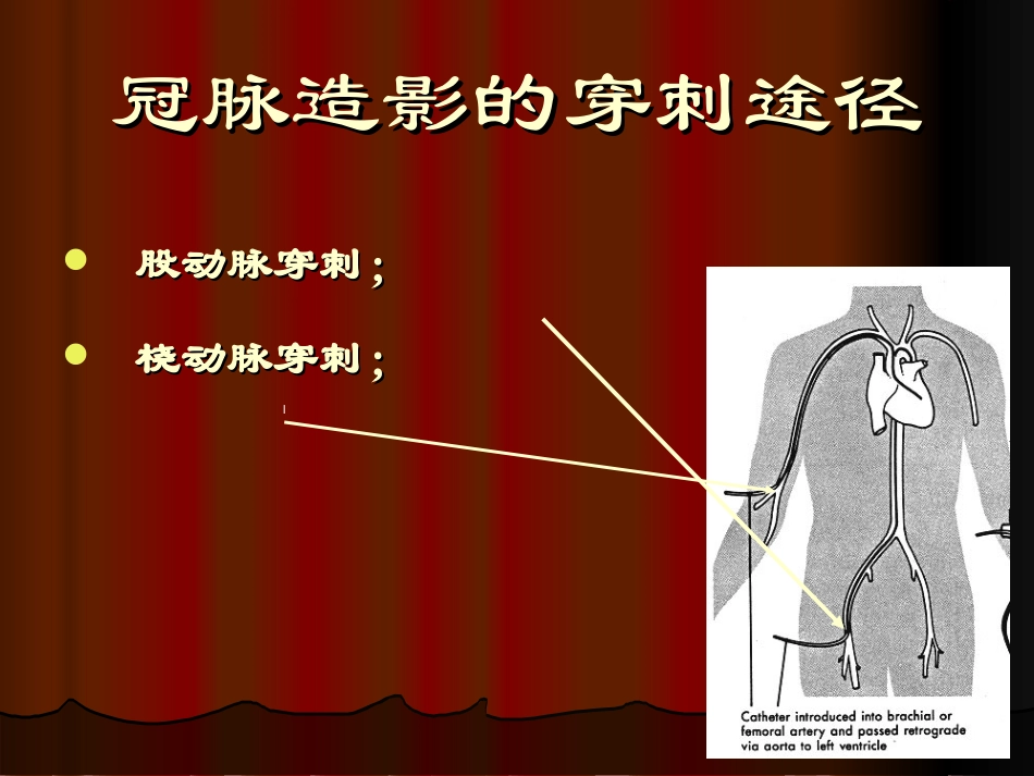 经股动脉冠脉造影术_第3页