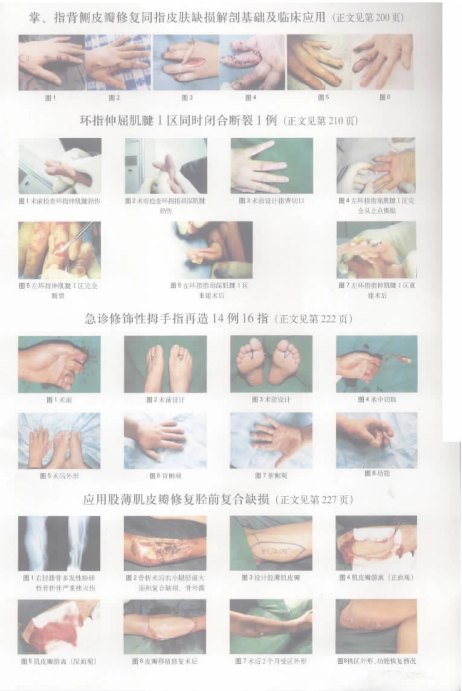 急诊修饰性拇手指再造14例16指_第3页