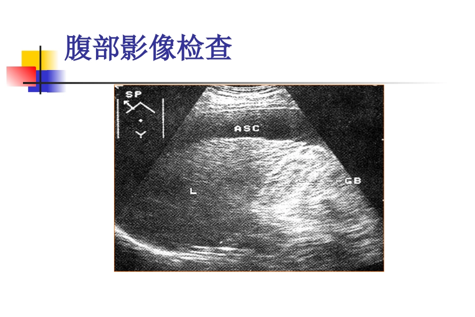 腹水的诊断以鉴别诊断_第3页