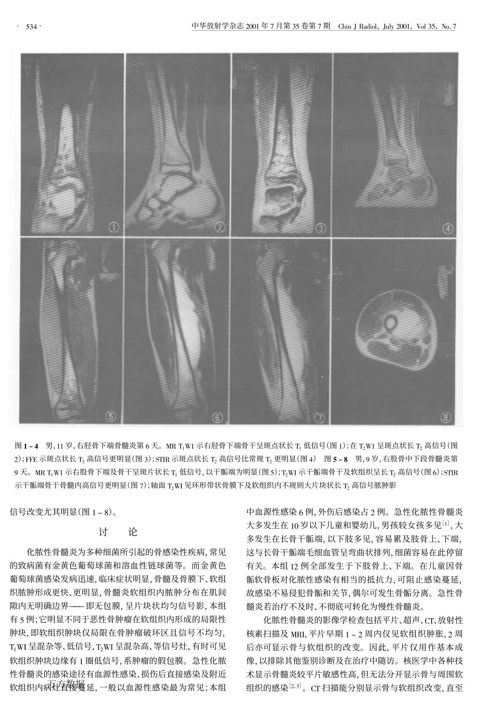 急性化脓性骨髓炎的MRI表现_第2页