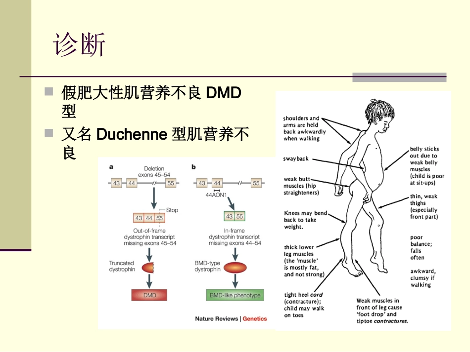 假肥大性肌营养不良_第3页