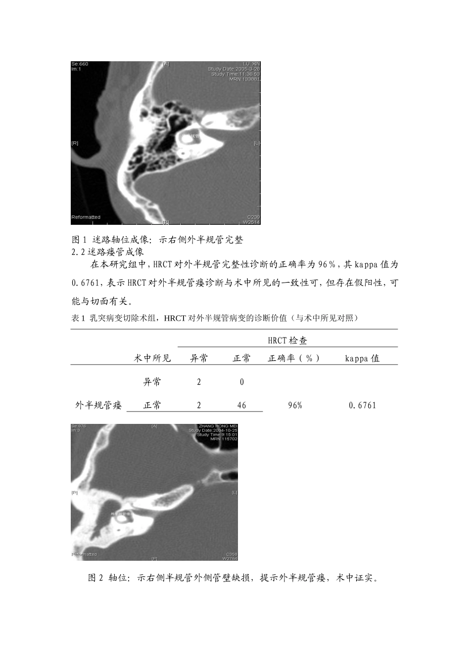 高分辨率CT不同重建技术评估迷路瘘管的价值_第2页