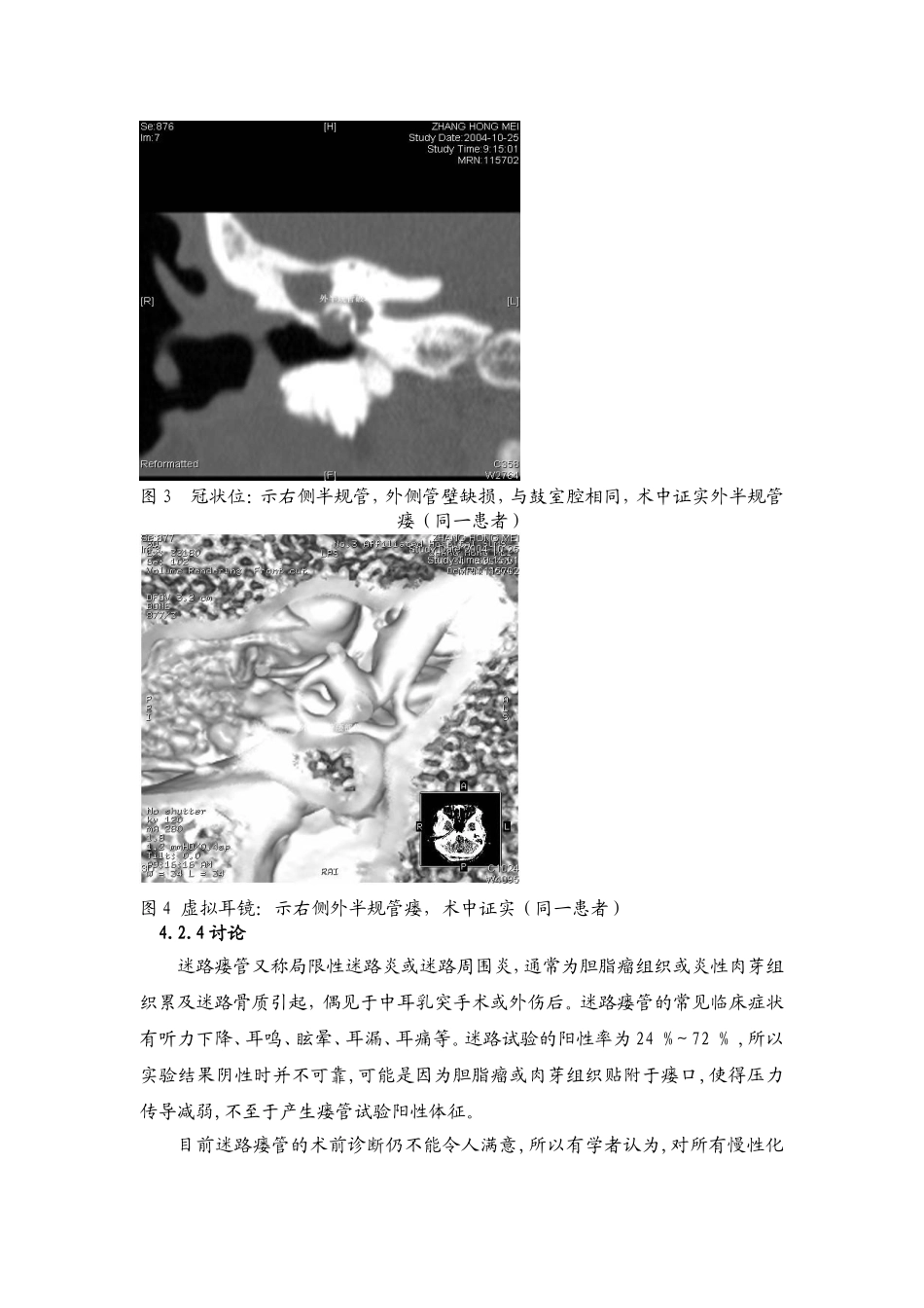 高分辨率CT不同重建技术评估迷路瘘管的价值_第3页