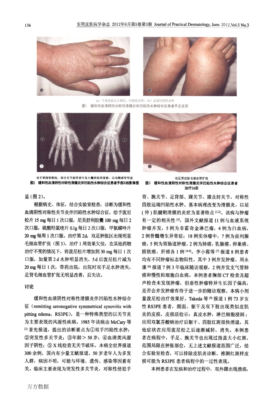 缓和性血清阴性对称性滑膜炎伴凹陷性水肿综合征一例并文献复习_第2页