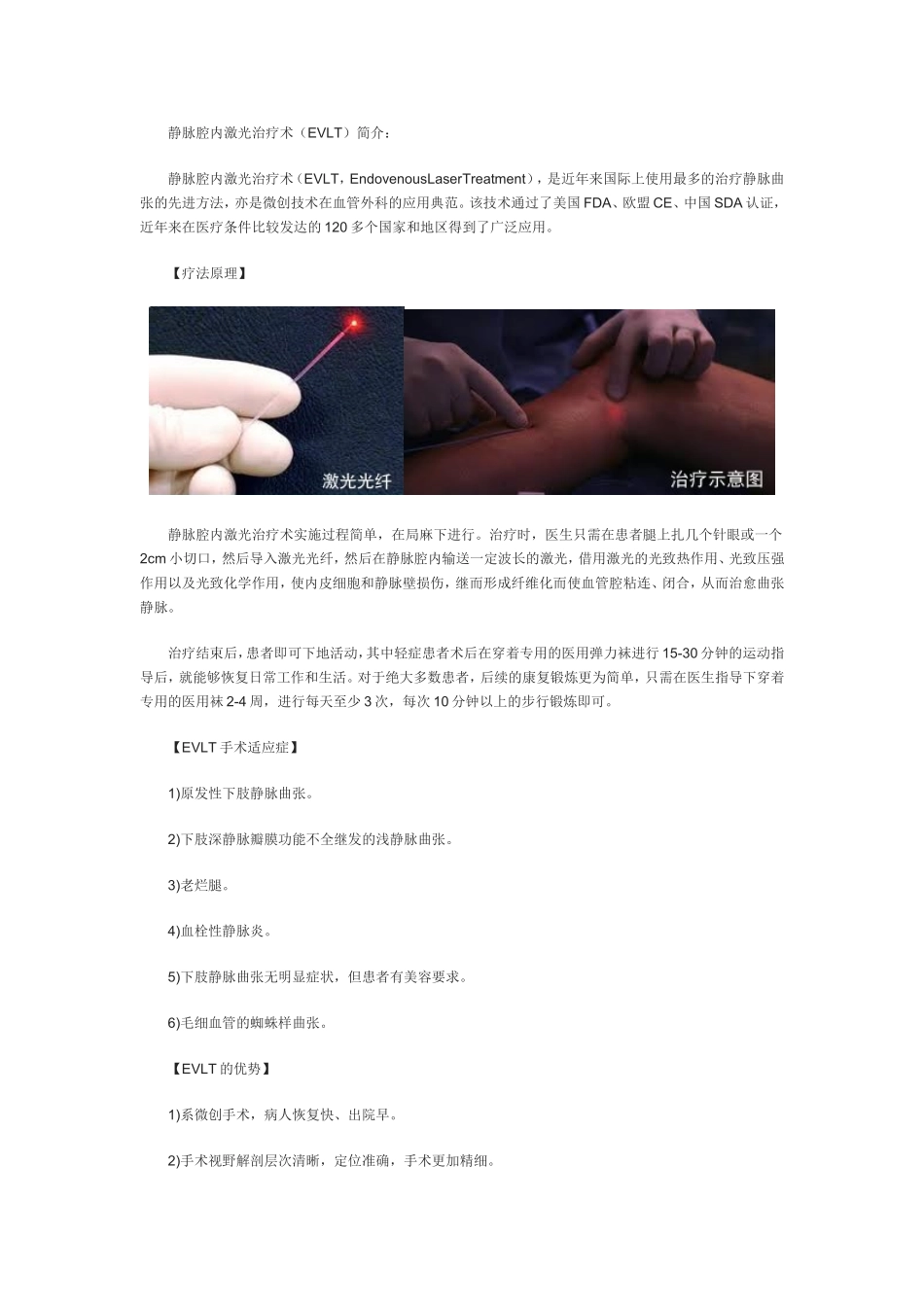 静脉腔内激光治疗术(EVLT)简介_第1页