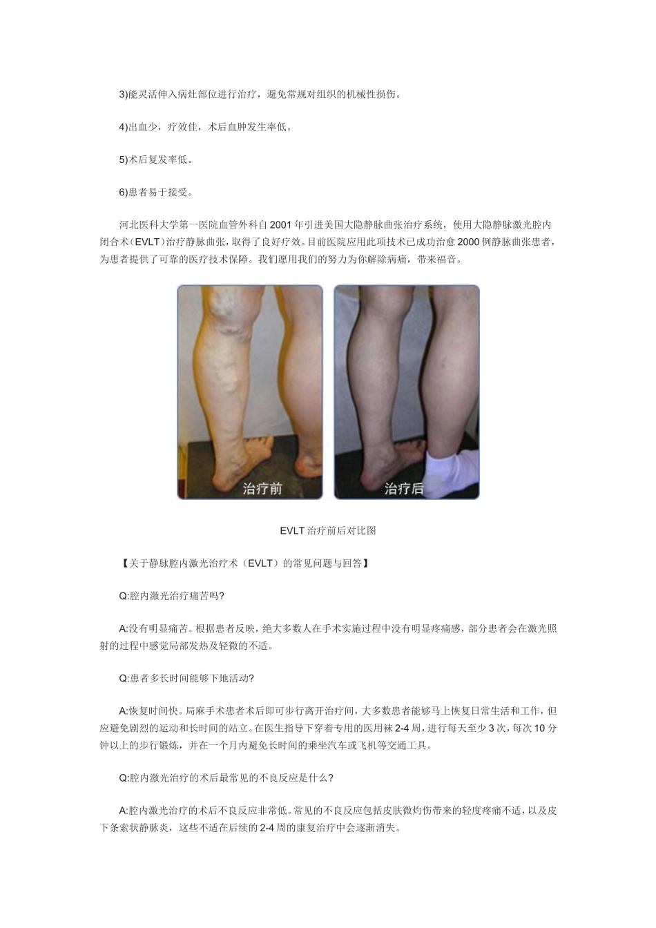 静脉腔内激光治疗术(EVLT)简介_第2页