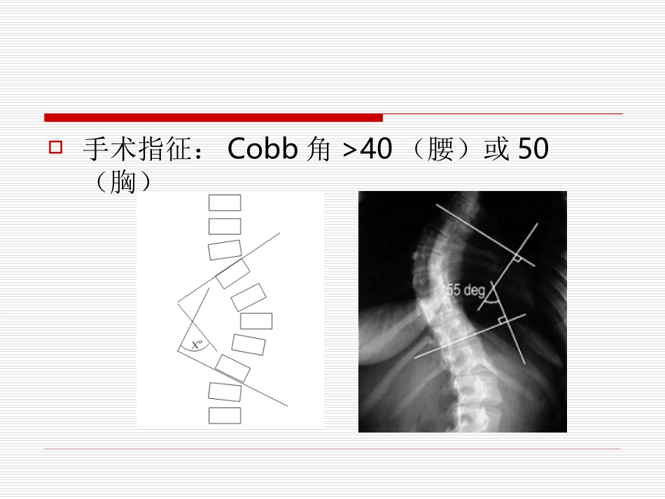 脊柱侧弯矫形术的麻醉问题_第3页