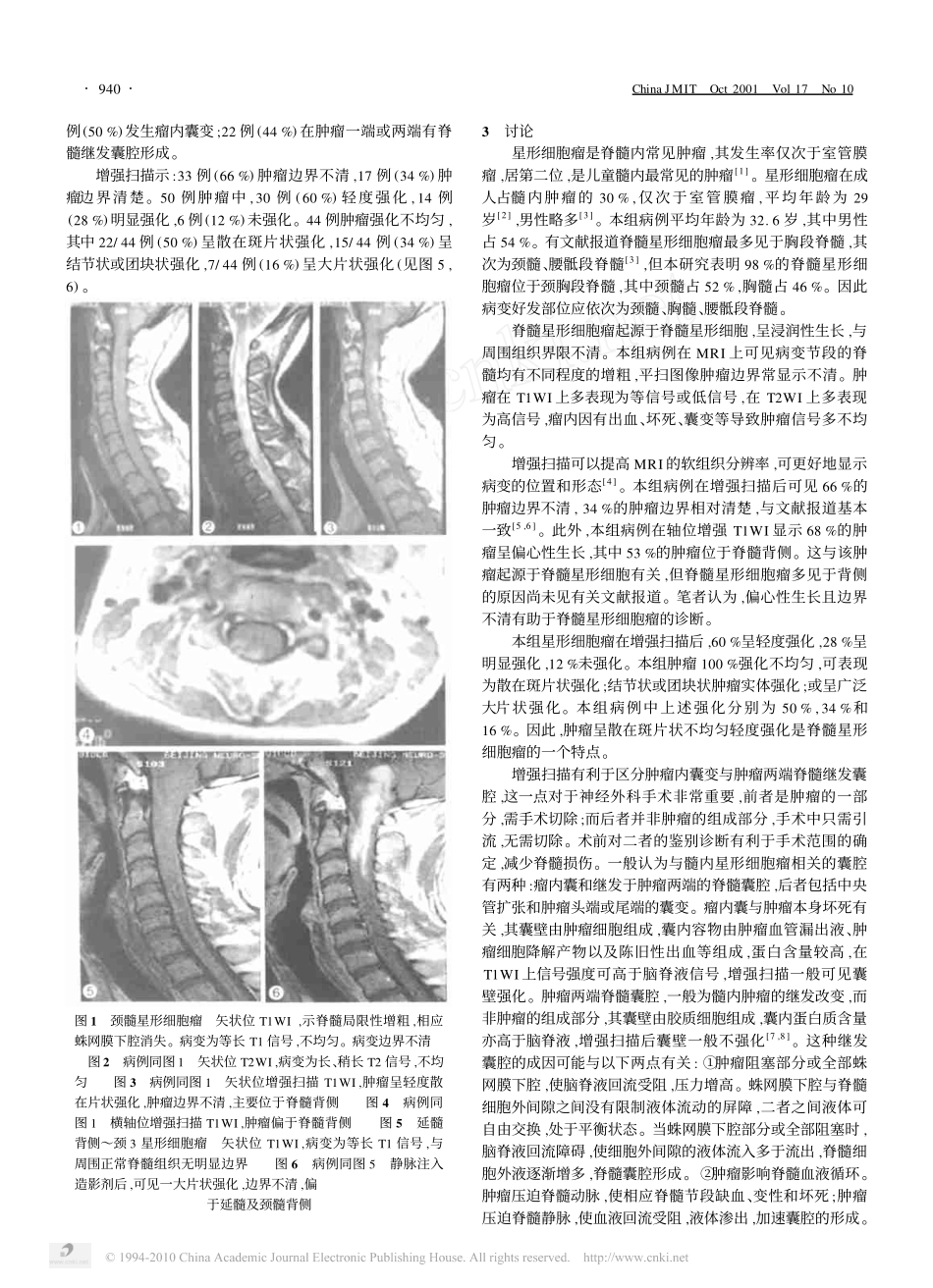 脊髓星形细胞瘤的MRI诊断_第2页