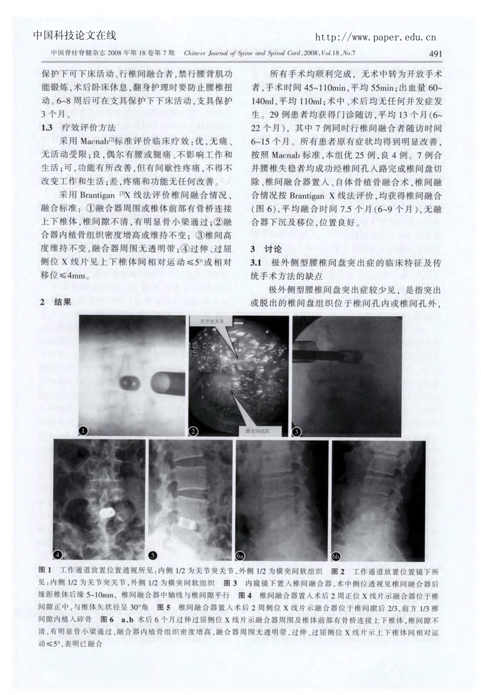 经椎间孔显微内窥镜下手术治疗_第3页