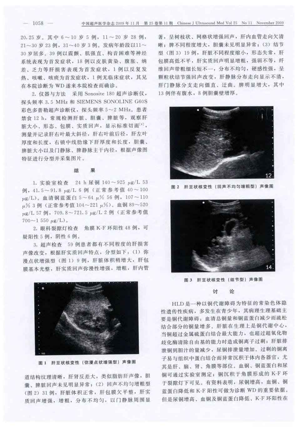 肝豆状核变性的超声诊断价值探讨_第2页