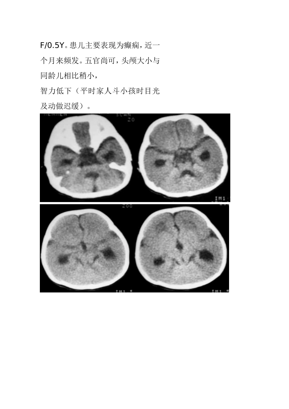 畸形：无、巨脑回畸形_第1页