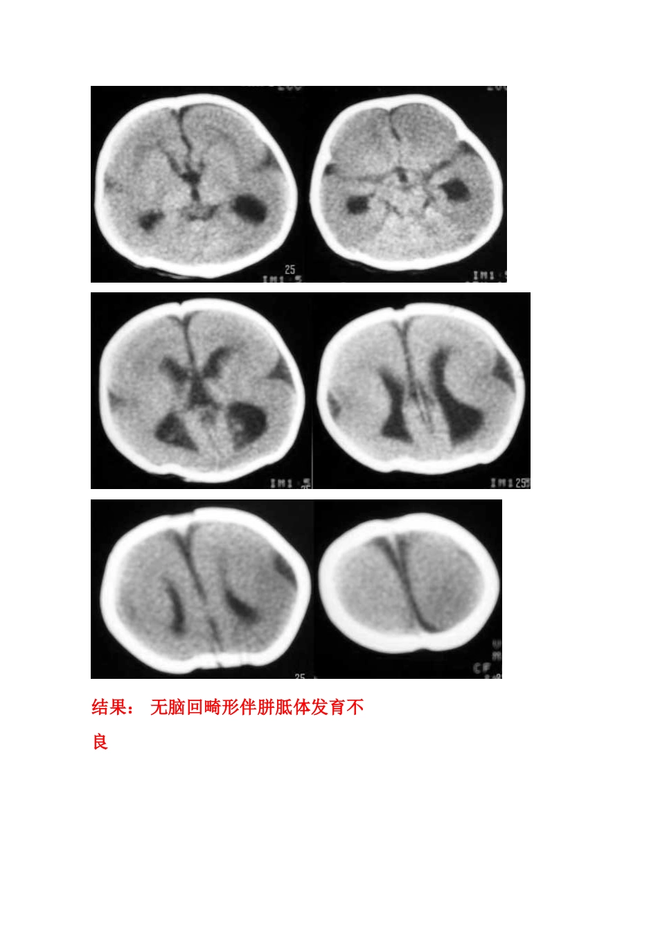 畸形：无、巨脑回畸形_第2页