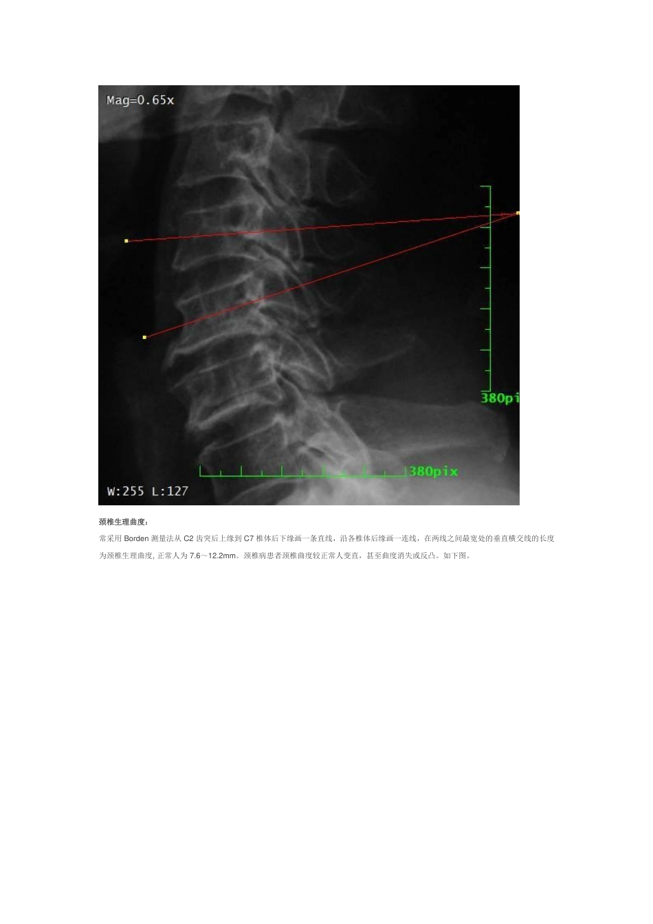 颈椎 X 线诊断_第3页