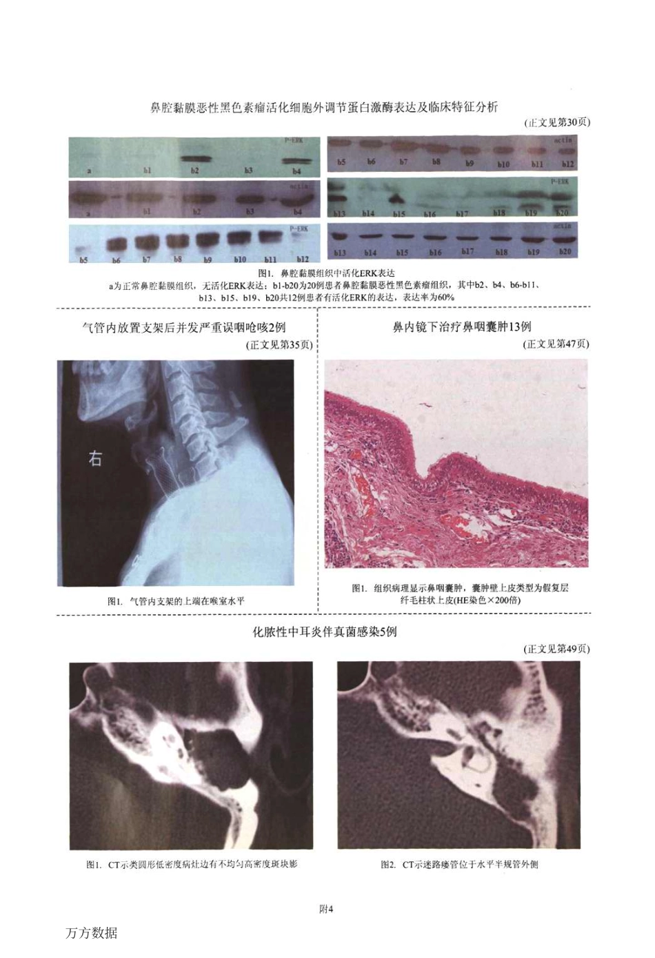 化脓性中耳炎伴真菌感染5例_第2页