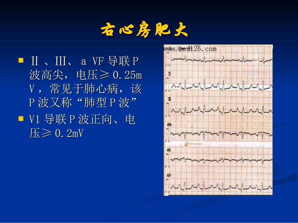 各种心电图表现_第2页