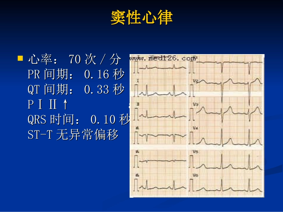 各种心电图表现_第3页