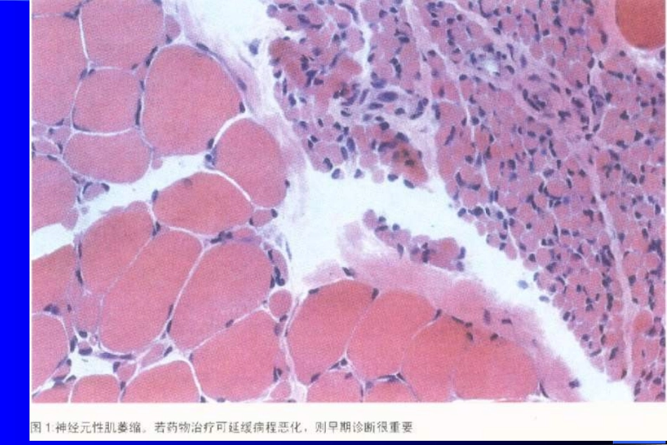 肌萎缩侧索硬化症_第1页