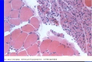 肌萎缩侧索硬化症