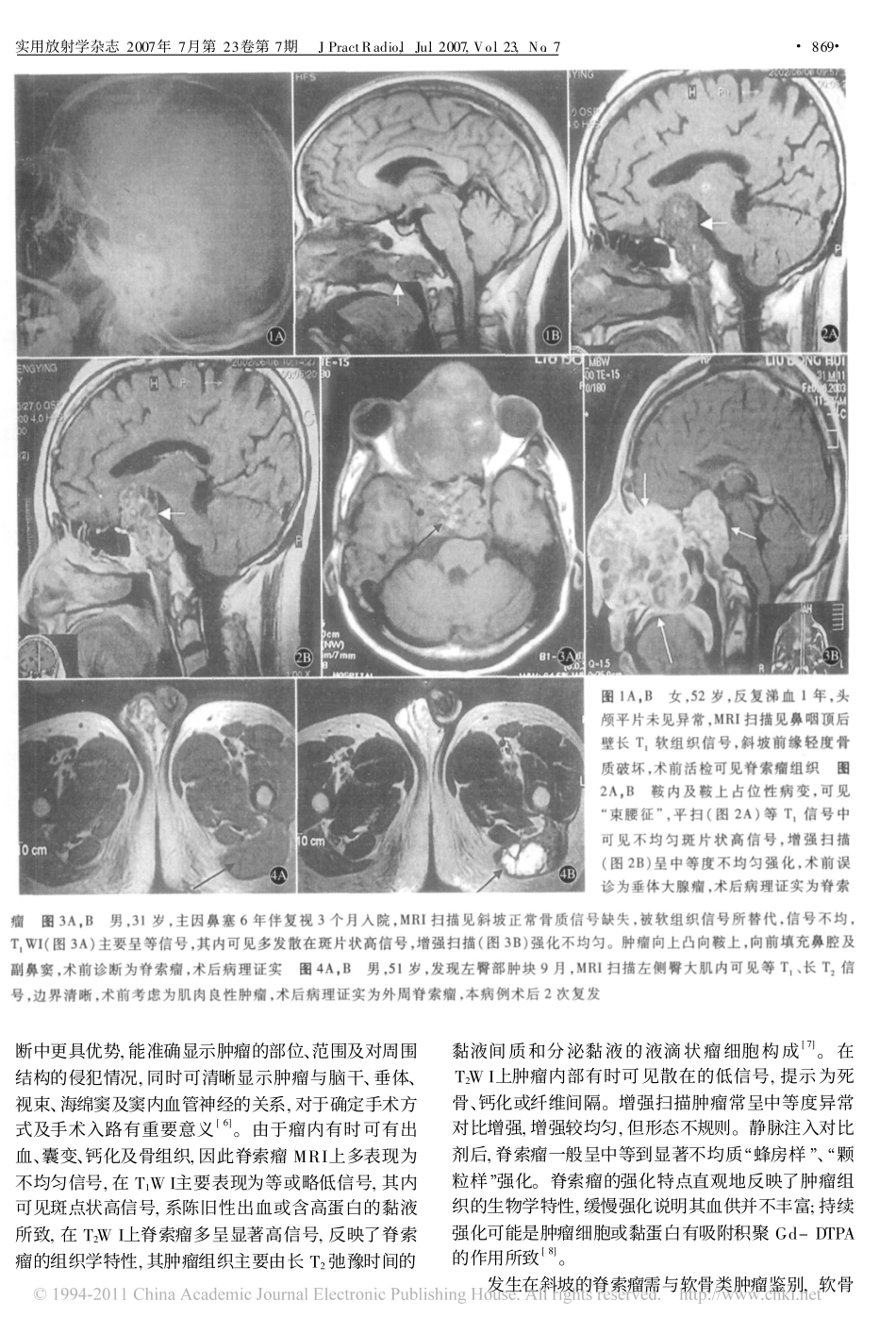 脊索瘤的影像学特点分析_第3页