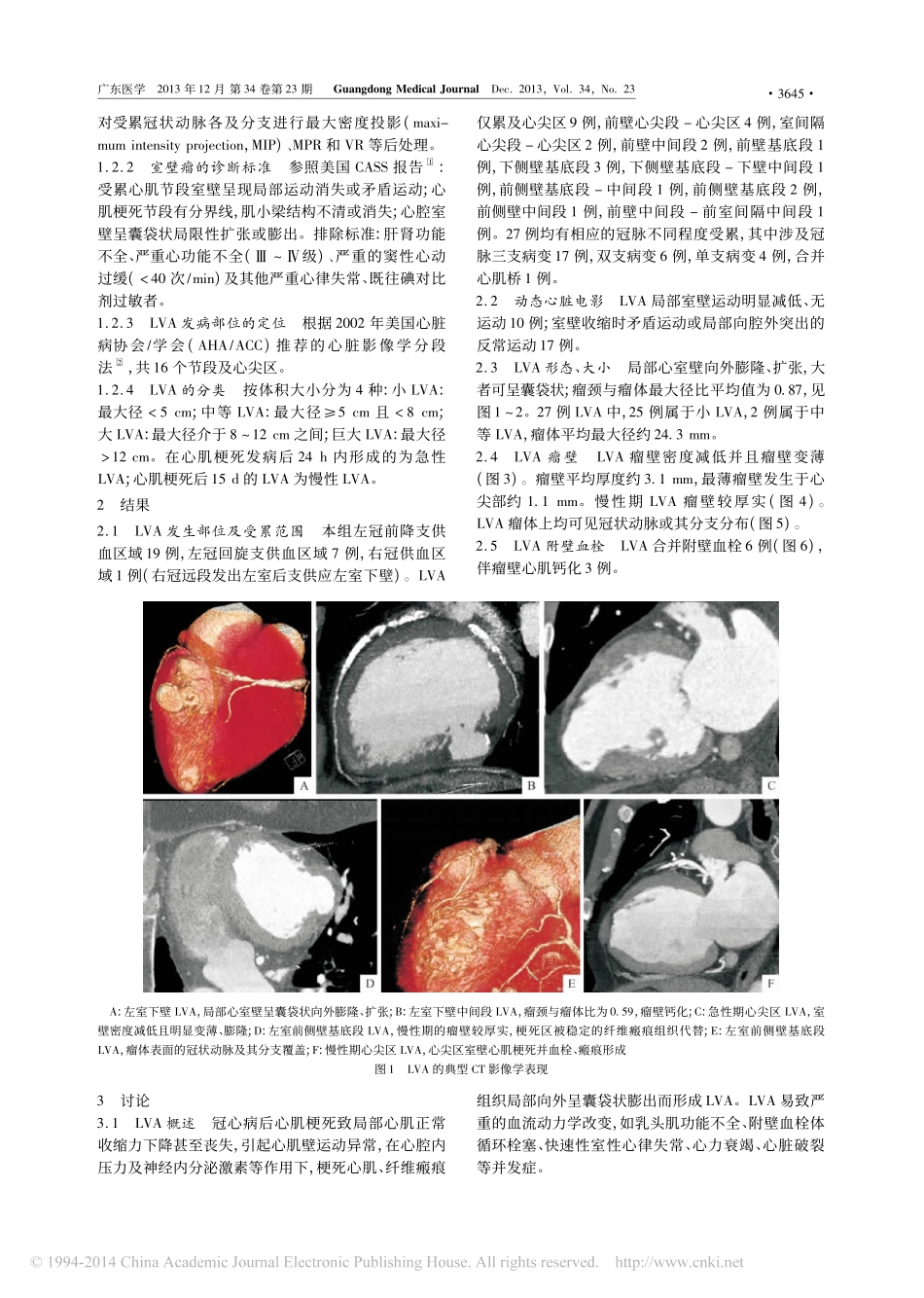 冠心病室壁瘤的CT影像学表现_第2页