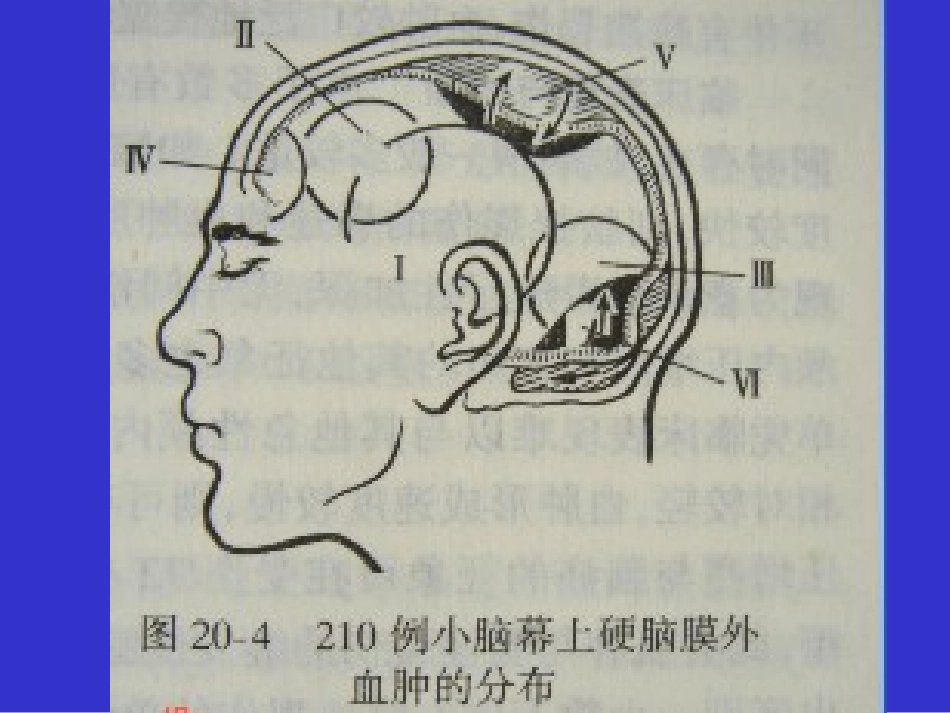 急性硬膜外血肿_第3页