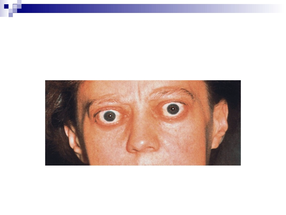 甲亢危象---纪晓栋(2011.3.13)_第3页