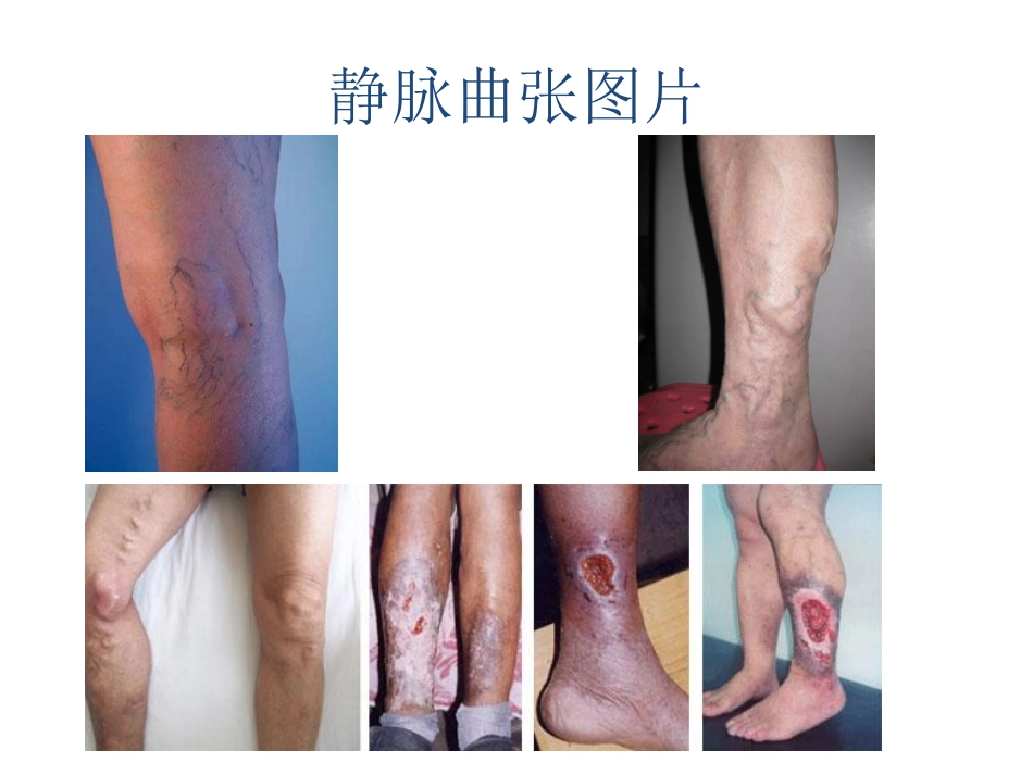 静脉曲张与护具选择_第2页
