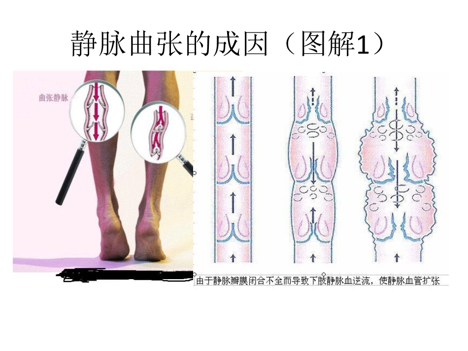 静脉曲张与护具选择_第3页
