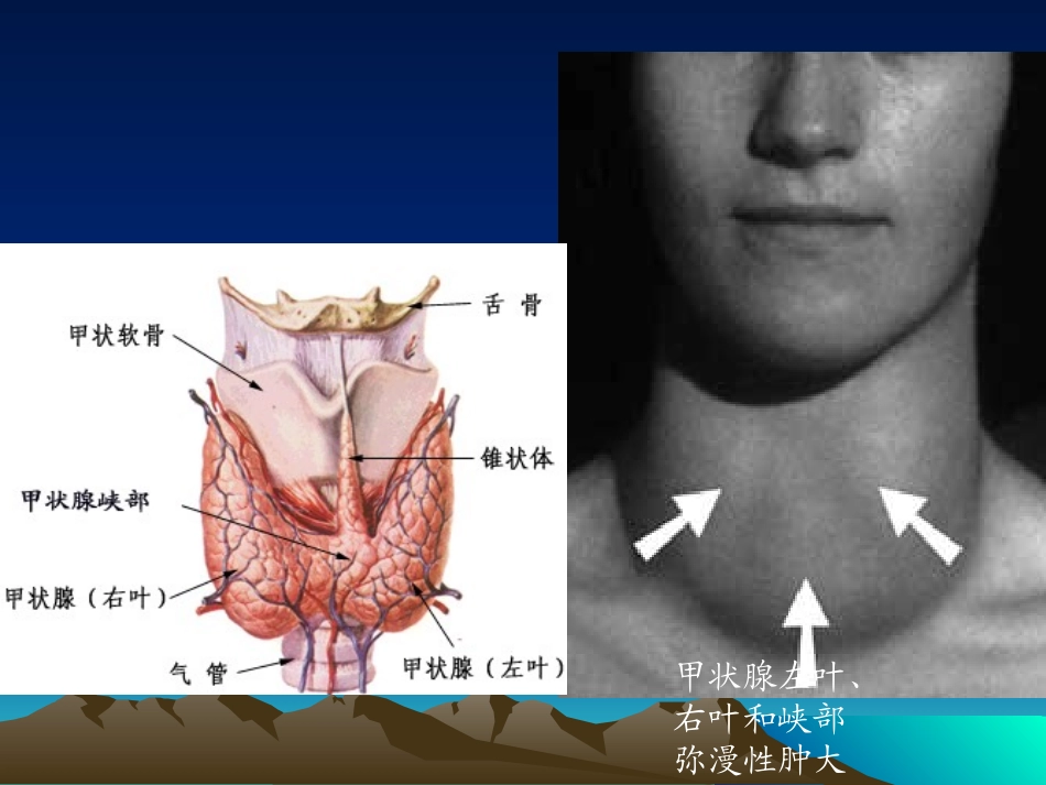 甲亢危象---_第2页