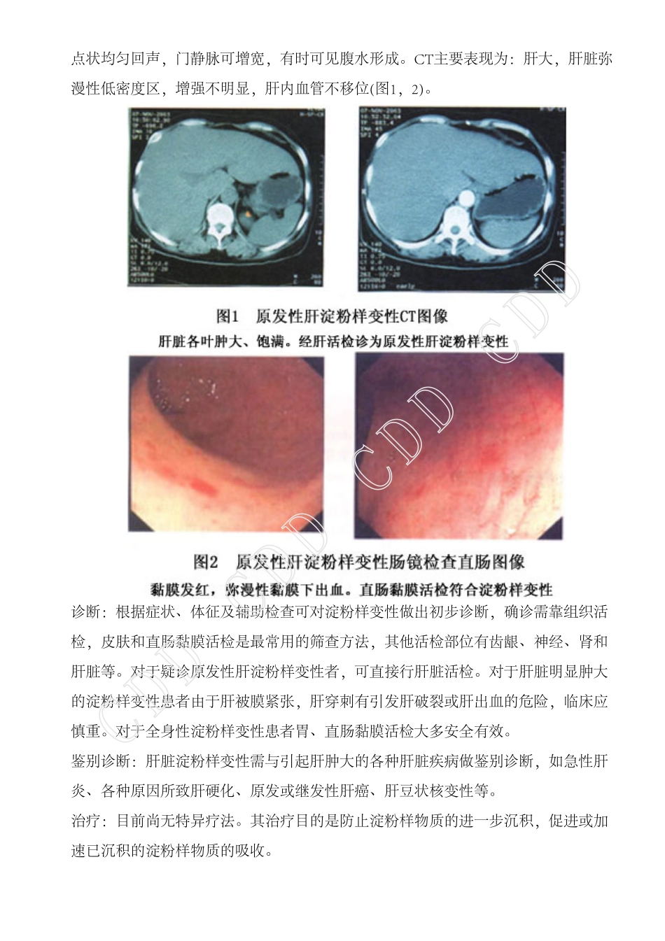 肝淀粉样变性_第3页