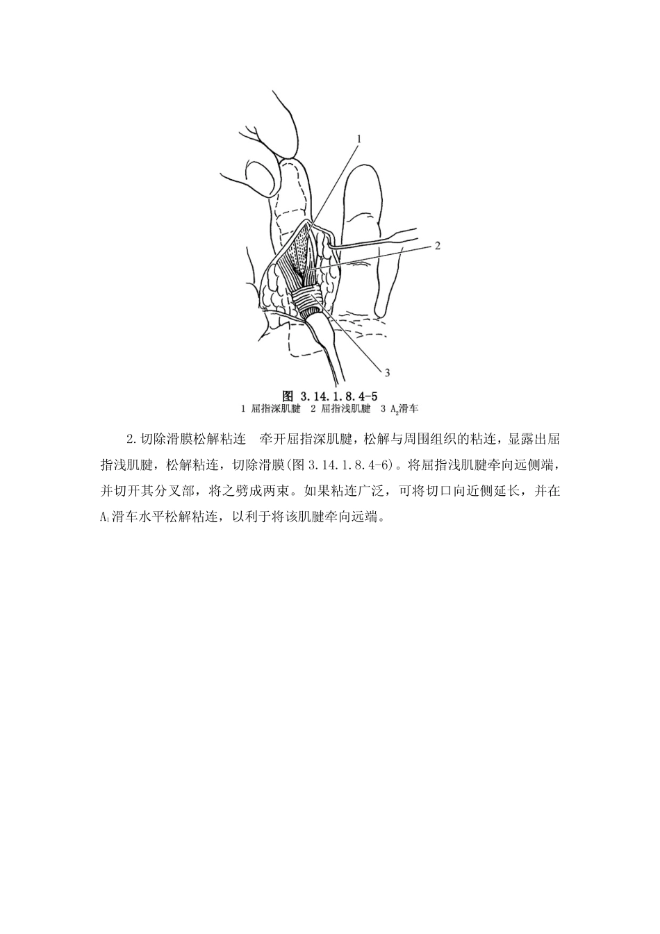 近侧指间关节过伸畸形矫正术_第3页