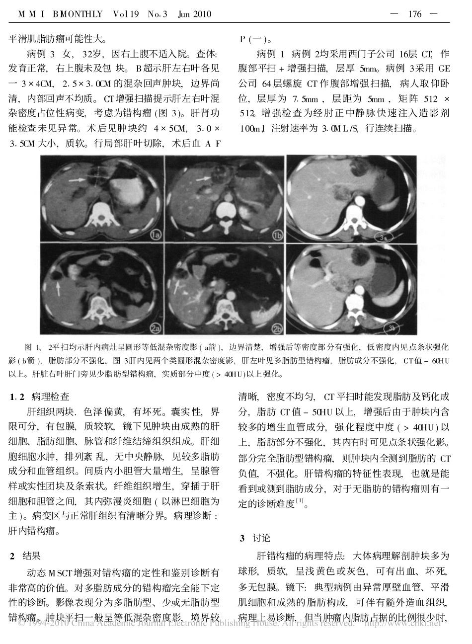 肝错构瘤的MSCT诊断_孙宗琼_第2页