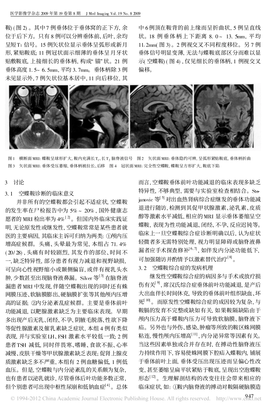 空蝶鞍综合症的MRI诊断_王家强_第2页