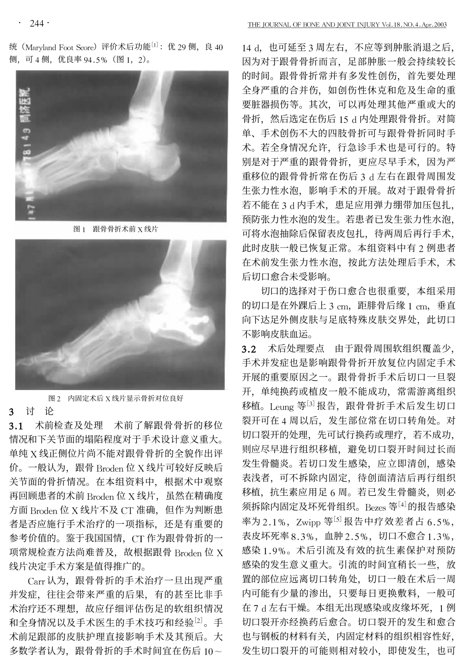跟骨骨折围手术期的处理_第2页