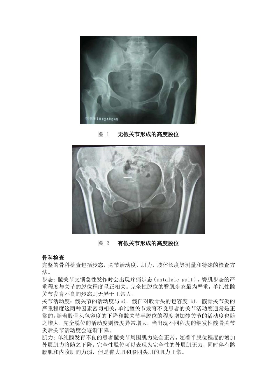 髋臼角和CE角_第3页