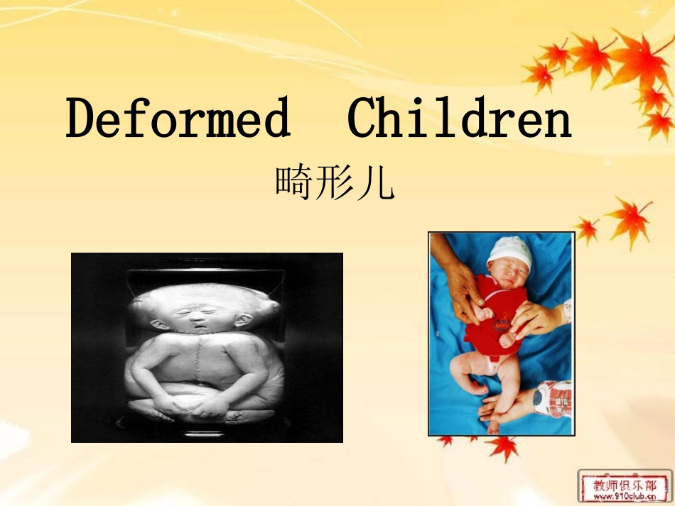 畸形儿  英文_第1页