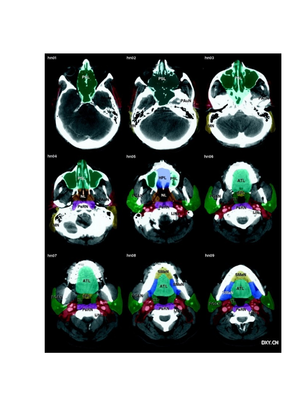 经典：全身淋巴结分区 CT 图谱_第3页