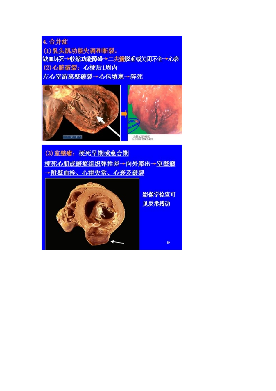 冠状动脉粥样硬化_第3页