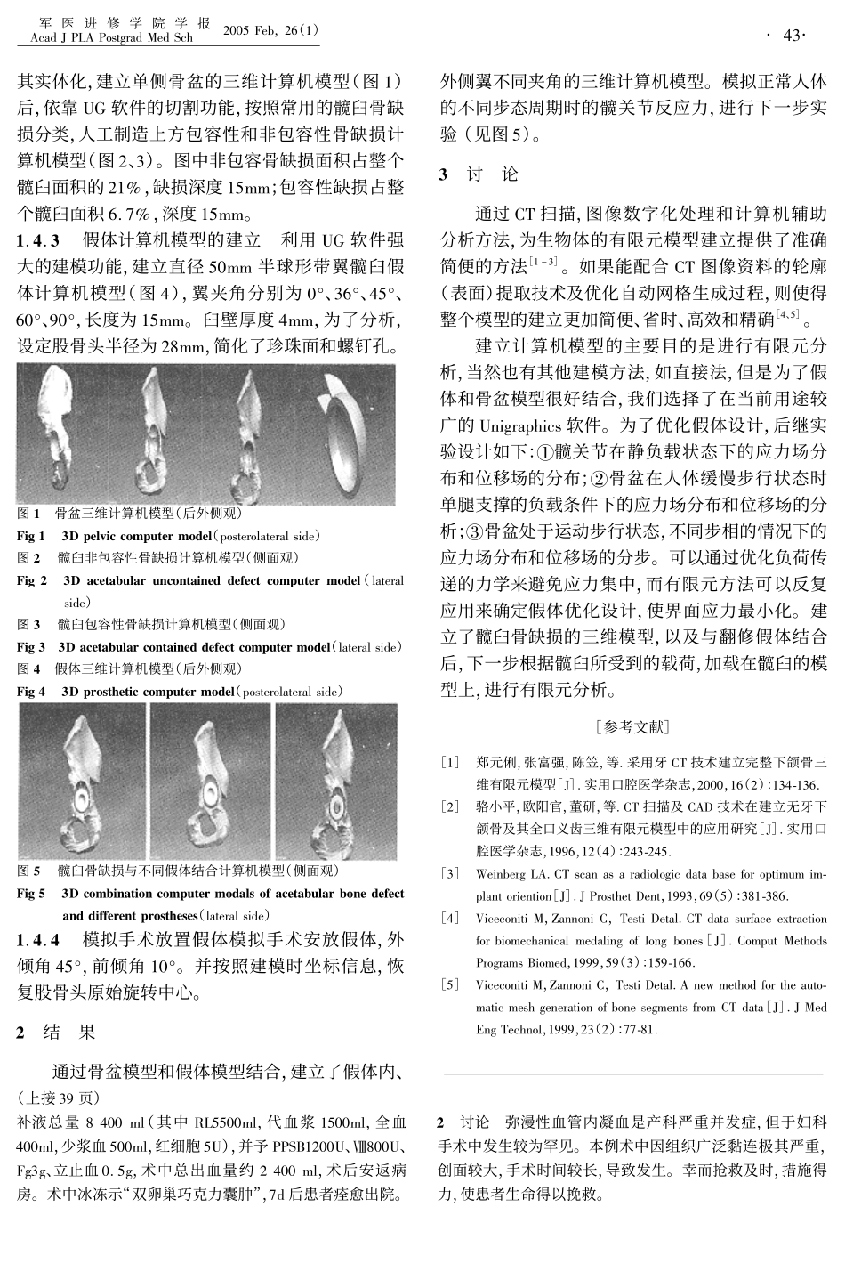 髋臼骨缺损和带翼髋臼翻修假体三维计算机模型的建立_第2页