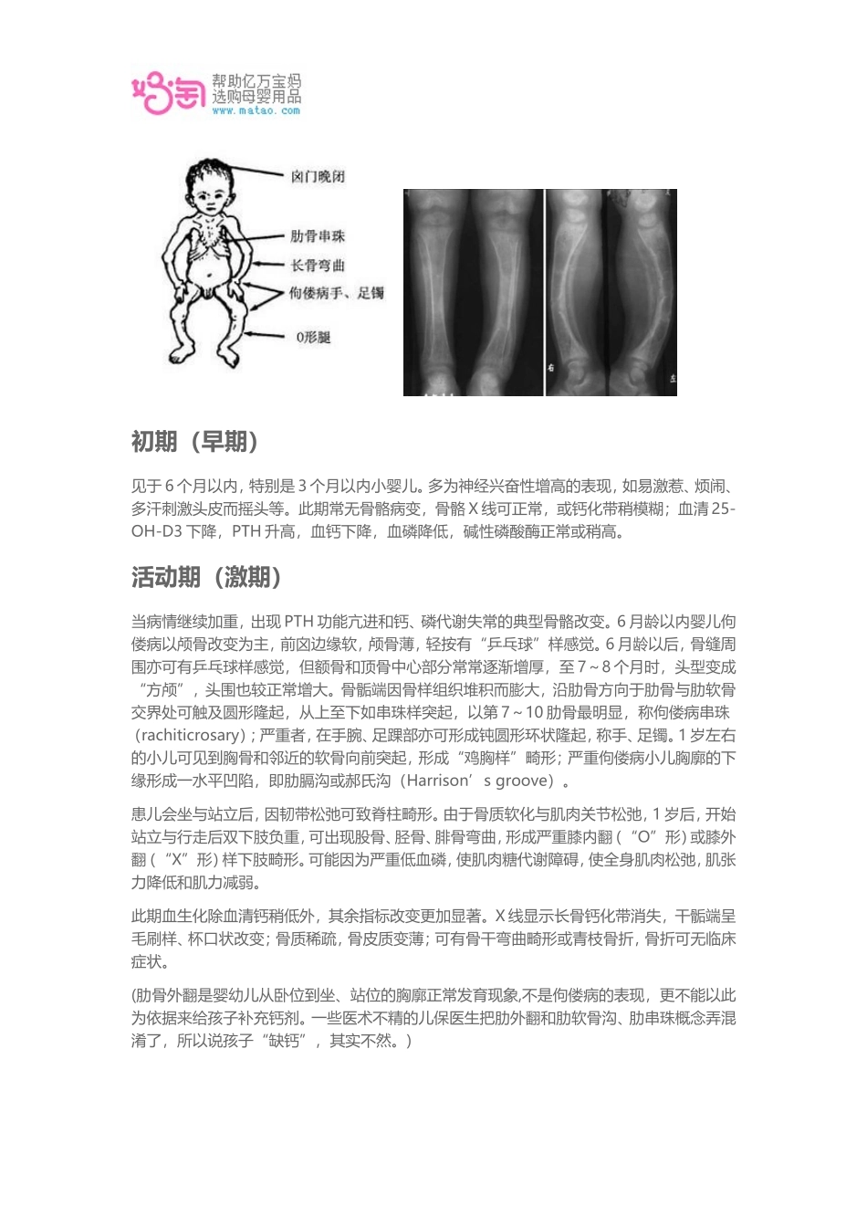 佝偻病症状表现_第2页