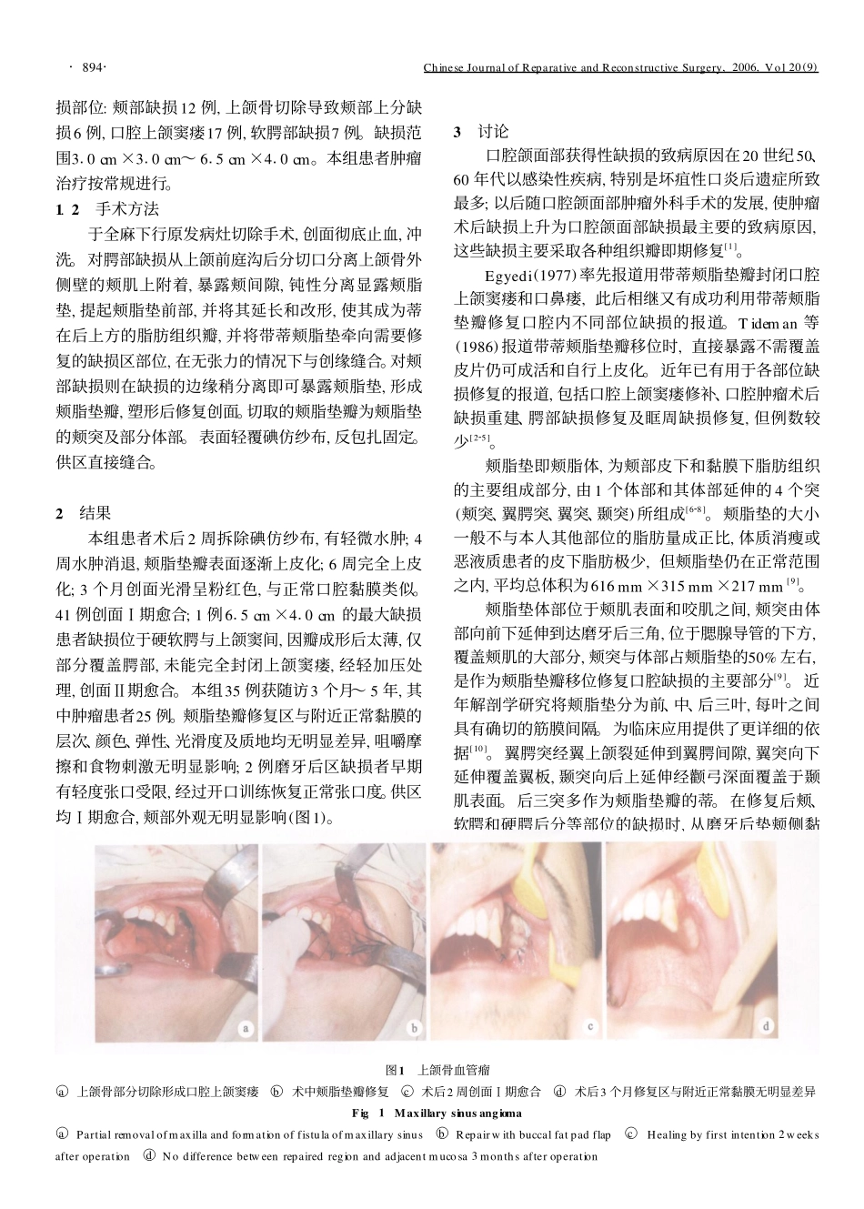 颊脂垫瓣在口腔缺损修复中的应用_第2页