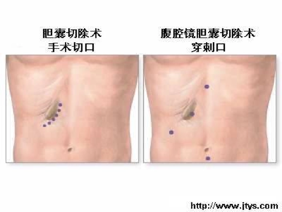 腹腔镜术前术后的护理11_第2页