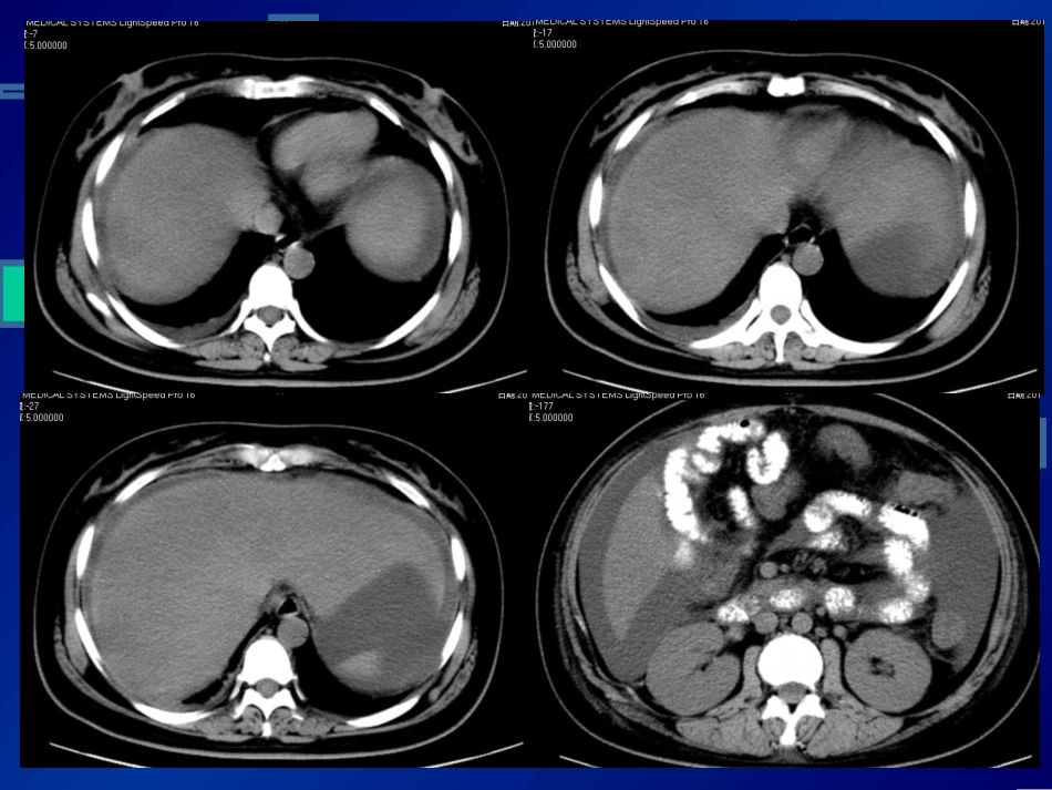 呼吸系统 胸水腹水_第1页