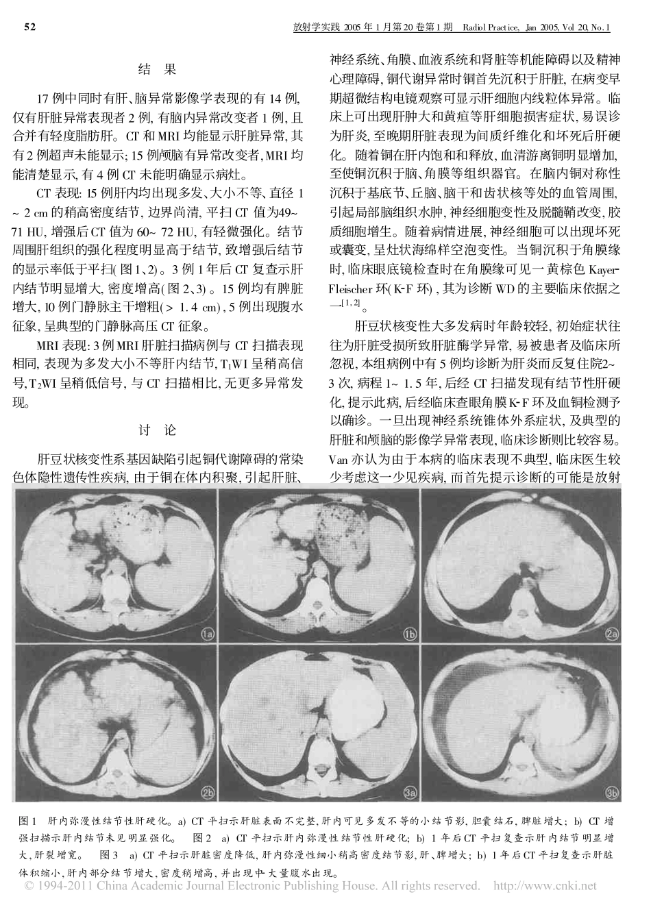 肝豆状核变性的肝影像学表现_第2页