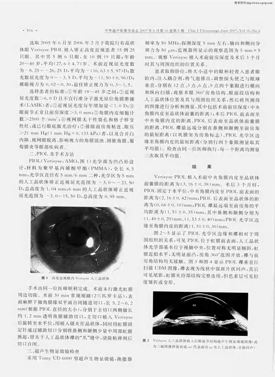 高度近视有晶状体眼虹膜固定型人工晶状体植人术后超声生物显微镜观察_第2页