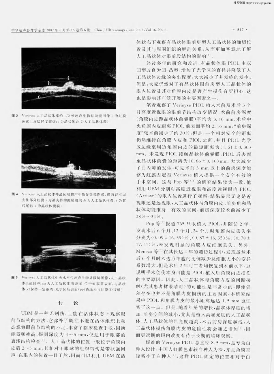 高度近视有晶状体眼虹膜固定型人工晶状体植人术后超声生物显微镜观察_第3页